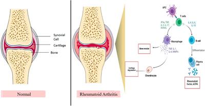 Exploring the therapeutic opportunities of potassium channels for the treatment of rheumatoid arthritis